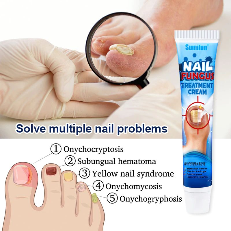 1Pcs Nail Fungus Removal Cream Onychomycosis Fungal Treatment