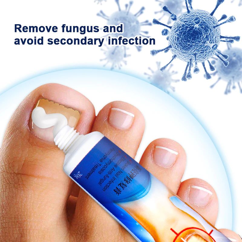 1Pcs Nail Fungus Removal Cream Onychomycosis Fungal Treatment