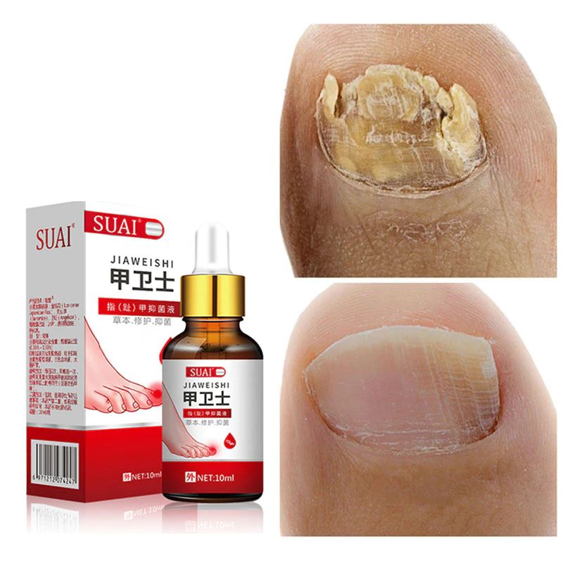 Nail Fungal Treatment Feet Care Essence Foot Whitening Toe Nail Fungus